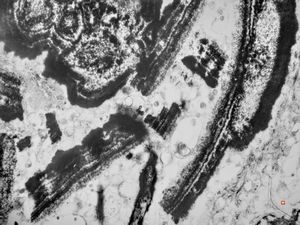 M,66y. | follicular cyst with hyaline Rushton bodies M,66y. | follicular cyst with hyaline Rushton bodies